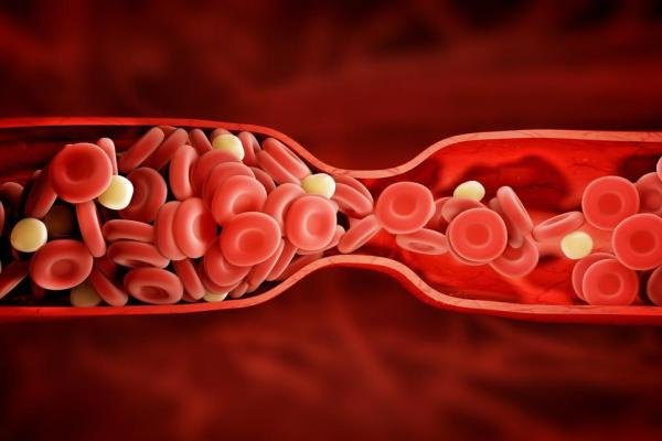 ارتباط رژیم غذایی چرب و بروز پلاک های چربی در عروق خونی