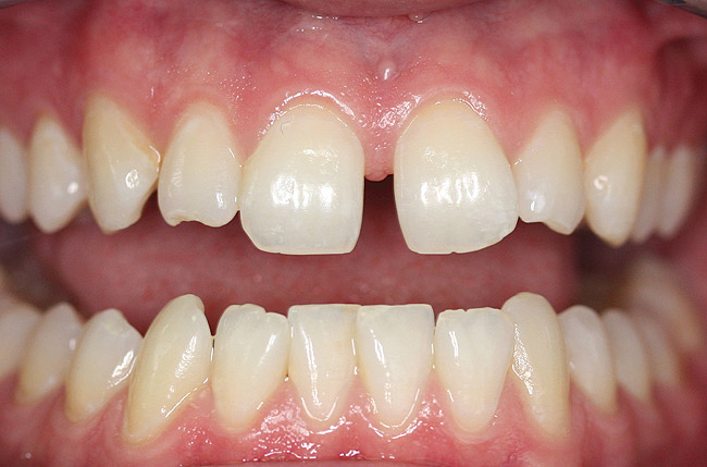 چگونه از بی نظمی و جابجایی دندان ها جلوگیری کنیم؟